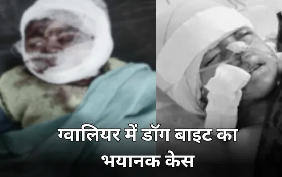डॉग बाइट का अब तक का सबसे वीभत्स केस: कुत्तों ने मासूम को 18 जगह काटा, डॉक्टरों ने लगाए 107 टांके