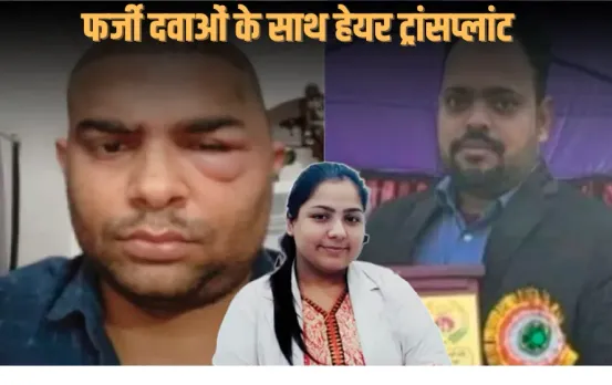 Hair Transplant News: हेयर ट्रांसप्लांट कांड में चौंकाने वाला खुलासा, विनीत के पर्चे पर न डॉक्टर का नाम, न इलाज की दिशा