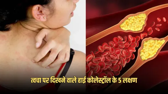 High Cholesterol Skin Symptoms