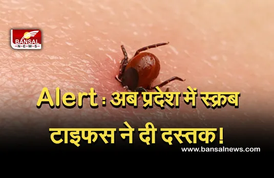 Scrub typhus in MP : सावधान! प्रदेश में सक्रब टाइफस की दस्तक! जानिए क्या हैं लक्षण और बचाव का तरीका