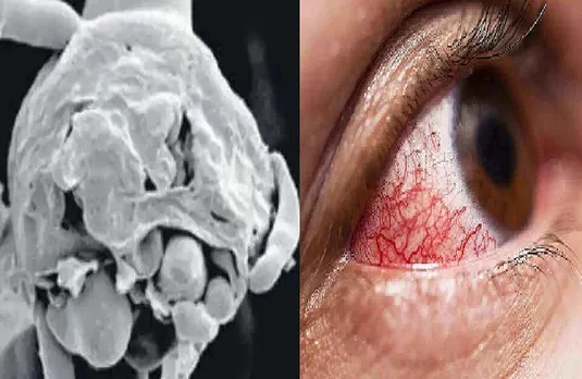 प्रदेश में व्हाइट फंगस के दो मरीज, जबलपुर व ग्वालियर में आए केस