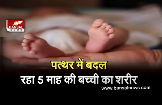 Ajab-Gajab News: घातक बीमारी की चपेट में आई 5 महीने की बच्ची, धीरे-धीरे पत्थर में बदल रहा शरीर