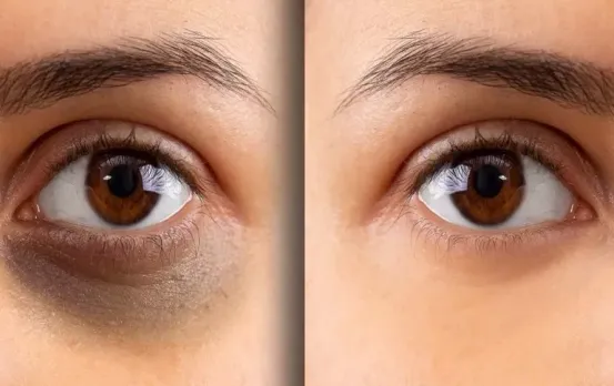 Dark Circles Removal Tips: घरेलू नुस्खे के सामने महंगी-महंगी क्रीम हो जाएंगी फ़ैल, 1 महीने में डार्क सर्कल्स होंगे खत्म