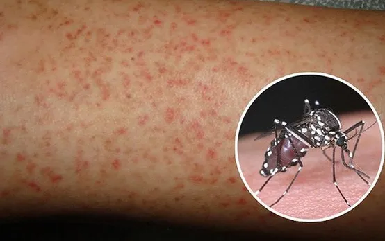 Dengue Precaution Tips: इस महीने बढ़ रहे डेंगू के मामले, ये वेरिएंट बन रहा जानलेवा, जानें कैसे करें बचाव