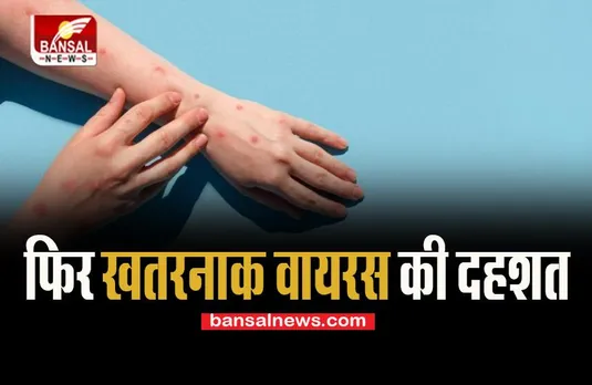 Monkey Pox Update: फिर खतरनाक वायरस की दहशत ! नाइजीरियन महिला में मिला संक्रमण