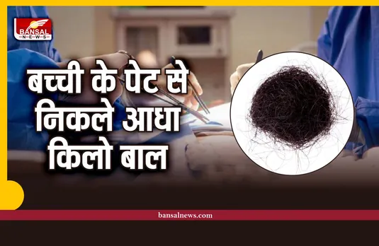 10 साल की बच्ची के पेट से डाक्टरों ने निकाले आधा किलो बाल