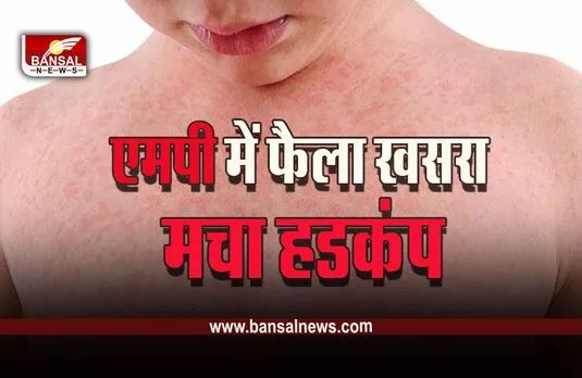 Indore Breaking : स्वास्थ्य विभाग में मचा हडकंप, प्रदेश के सबसे बड़े शहर में एक साथ मिले खसरे के 11 मरीज, जांच शुरू