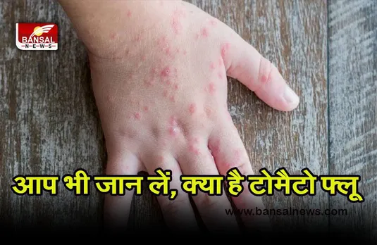 Tomato Flue : क्या है टोमैटो फ्लू, जो तेजी से बच्चों को बना रही अपना शिकार, जानें लक्षण और बचाव