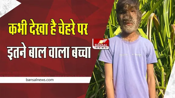 MP Ratlam Boy Face Story: चेहरे पर लंबे-लंबे बाल देख लोग बुलाते थे हनुमान ! वेयरवुल्फ सिंड्रोम बीमारी से है पीड़ित