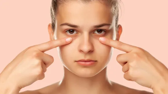 eyes-dark-circles