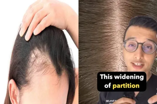 Baldness