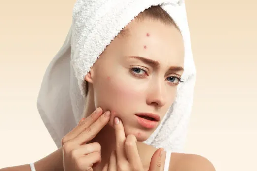 How to Get Rid of Pimples