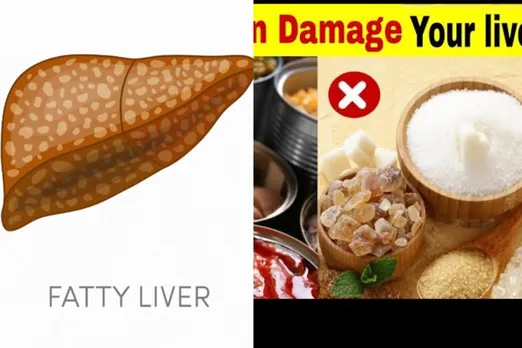 Fatty liver