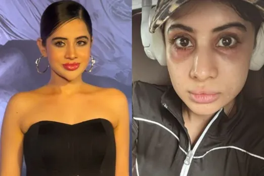 Uorfi Javed Shares Pic Of Swollen Face And Asks For Help