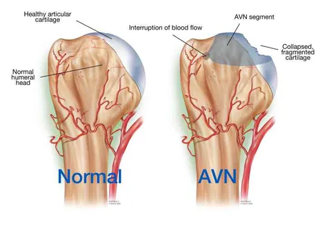 AVN