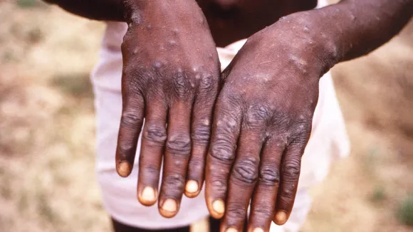 monkeypox