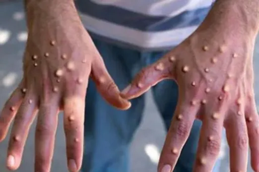 Monkeypox