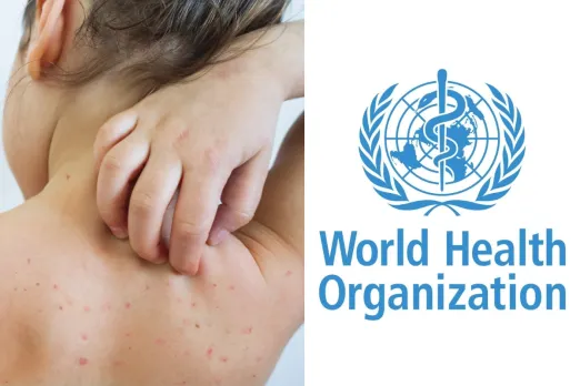 Measles