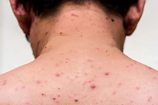 WHO on measles