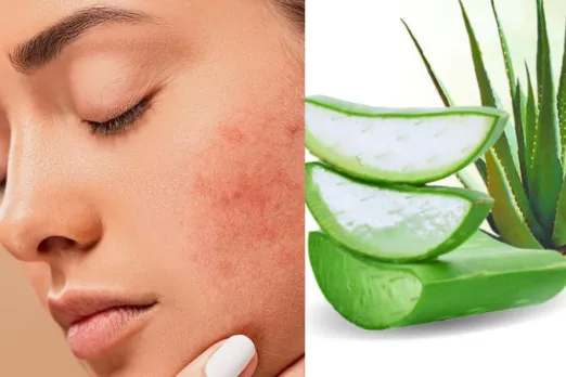 Acne Tips
