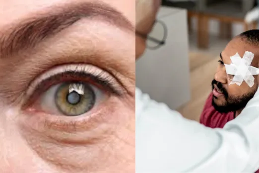 Cataract