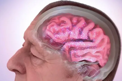 Alzheimer's disease