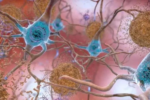 Alzheimer's