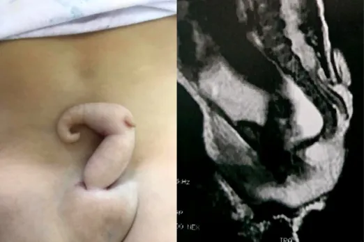 Rare spinal defect
