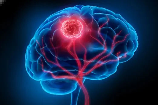 Brain Metastasis