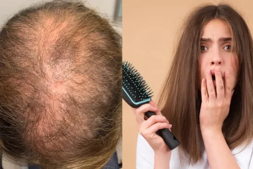 Hair loss