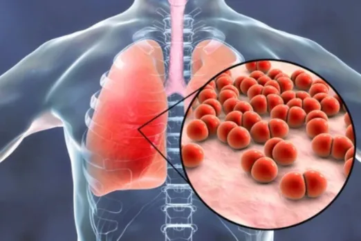 Pneumonia