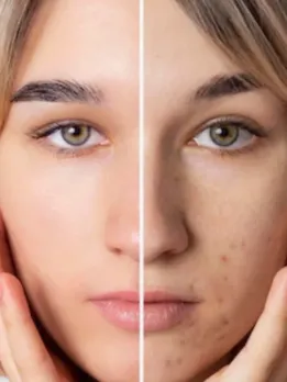 10 Remedies for Sunburnt Skin