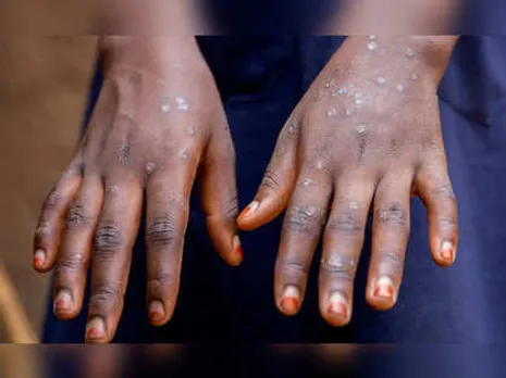 Mpox