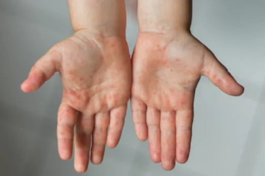 Monkey Pox