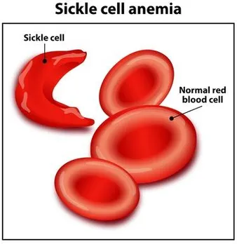 Indian Scientists Develop A Portable And Affordable Diagnostic Kit For A Blood Cell Disorder