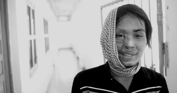 TBI Blogs: A New Legislation Is Giving Acid Attack Survivors in India Hope for Their Futures