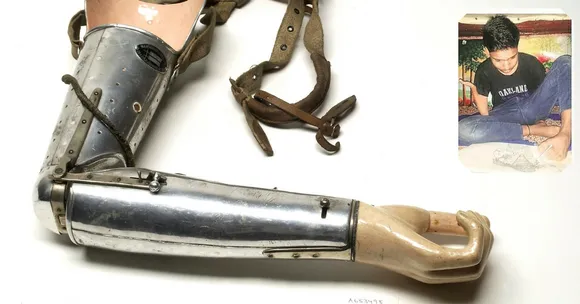 Delhi High Court Gives 16-Year-Old Foot Artist New Lease of Life With a Prosthetic Arm!