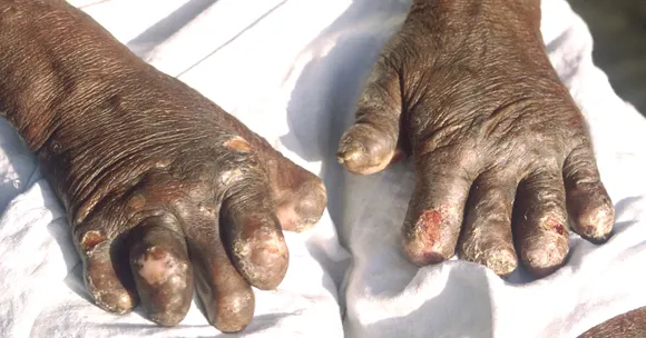 Prevent Stigma, Eradicate Leprosy: Why Indians Must Care About The SC's Directions
