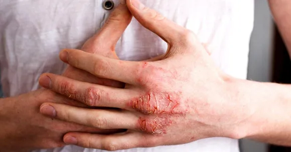Hands Feeling Itchy and Raw? Study Shows How Your Dish Soap Could Be to Blame