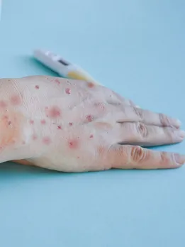 ‘Tomato Flu’ Outbreak Among Children in India; What We Know So Far