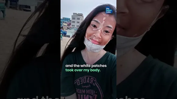 Vitiligo isn’t my weakness. It’s my identity!