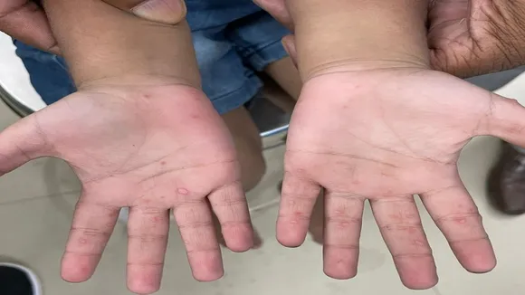 Tomato Flu, viral diseases, India, disease, Hand Foot and Mouth Disease,