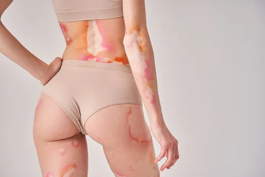 A woman's body with rashes and red patches caused by autoimmune diseases in women