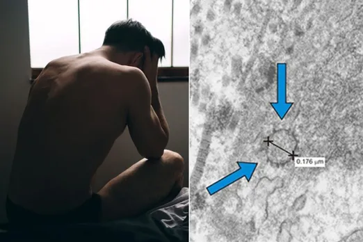 Man lost 1.5 inches from the length of his penis after Covid