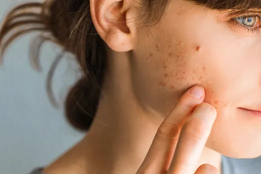 Teen+Girl+with+Hormonal+Acne