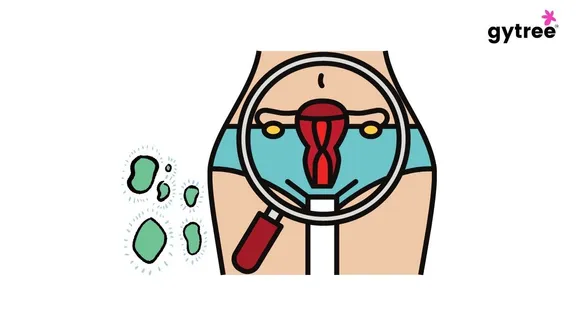 Bacterial vaginosis and it’s symptoms