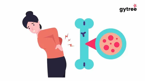 Menopause and osteoporosis