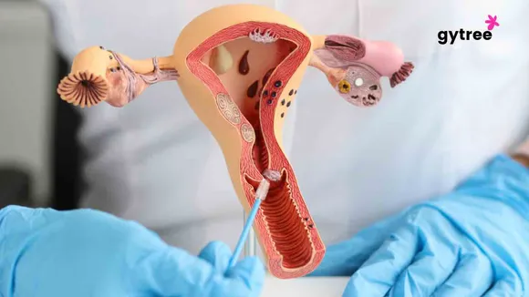 Hysterectomy