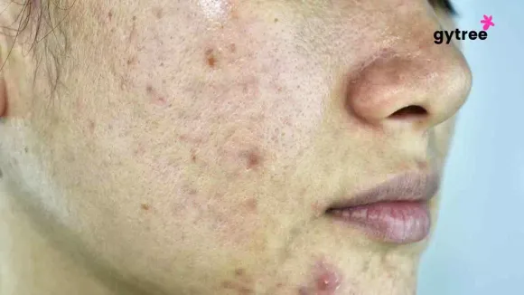 Skin pigmentation:8 effective tips to treat