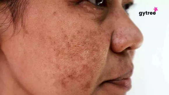 Say Goodbye to Melasma: 6 Effective remedies